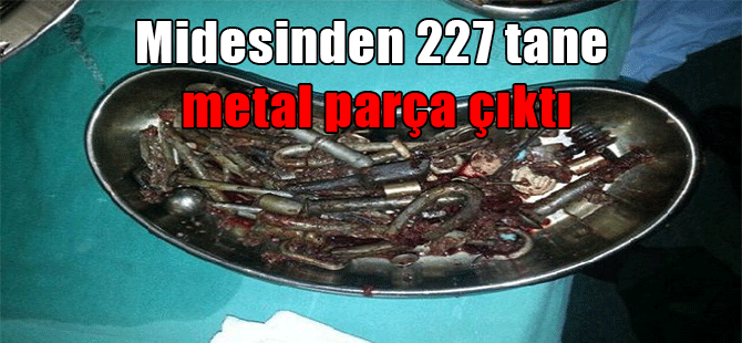 Midesinden 227 tane metal parça çıktı