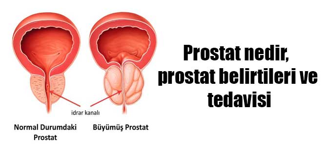 Prostat nedir, prostat belirtileri ve tedavisi