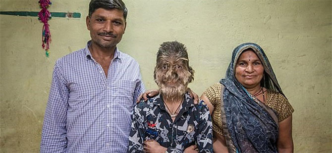Hintli öğrenci ender görülen bir hastalık nedeniyle ‘kurt adam’a dönüştü