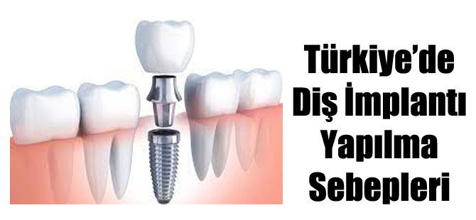 Türkiye’de Diş İmplantı Yapılma Sebepleri